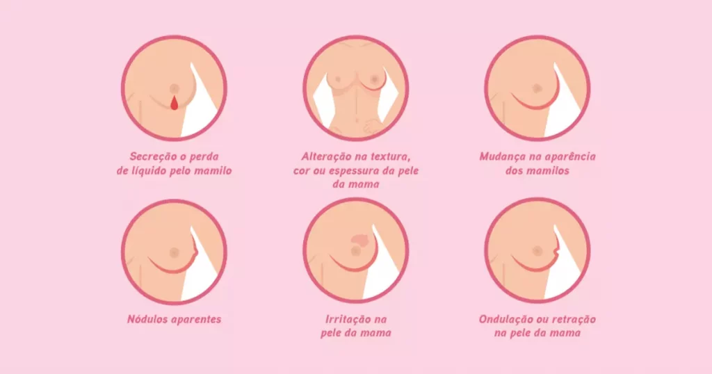 Outubro Rosa - Alguns sintomas do câncer de mama